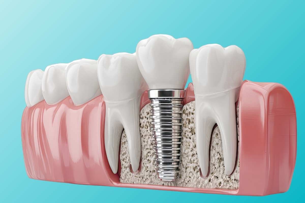 Illustration of a dental implant and crown anchored in the jawbone beside natural teeth